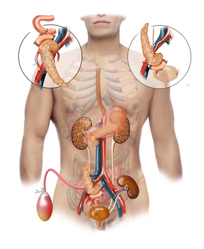 animated pancreas transplant